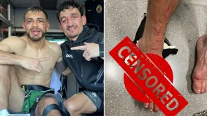 Yair Rodriguez pokazao užasnu ozljedu stopala koju je zaradio u 'ratu' s Hollowayem!