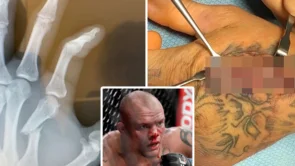 Anthony Smith priznao da je umalo amputirao prst kako bi nastavio svoju UFC karijeru