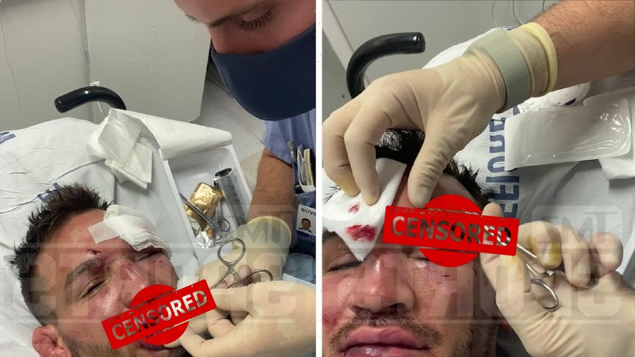 Pogledajte proces šivanja Michaela Chandlera nakon meča s Justinom Gaethjeom!