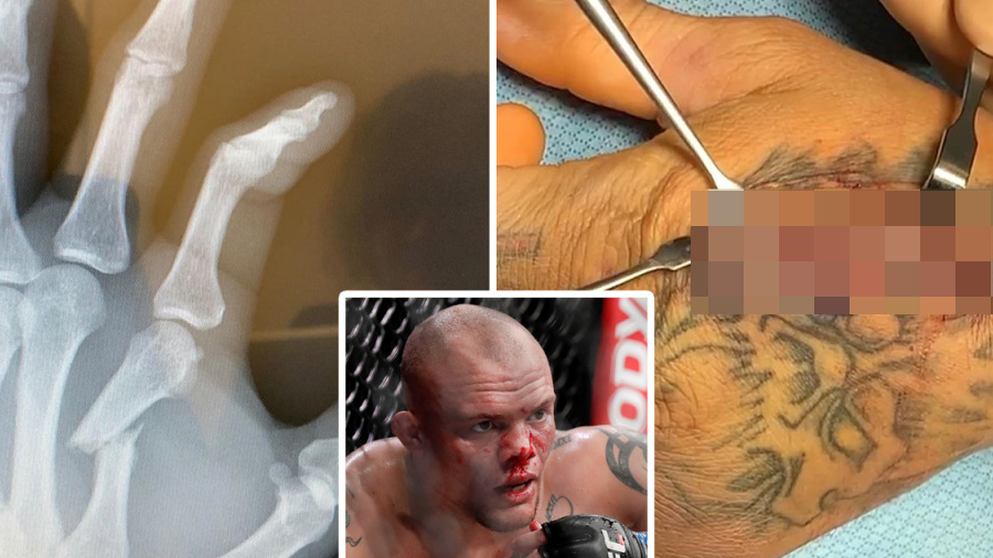 Anthony Smith priznao da je umalo amputirao prst kako bi nastavio svoju UFC karijeru