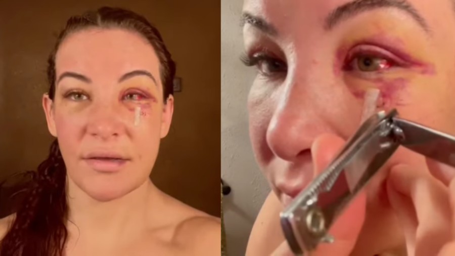 Bizarno ili praktično? Miesha Tate sama sebi uklanja kirurške šavove!